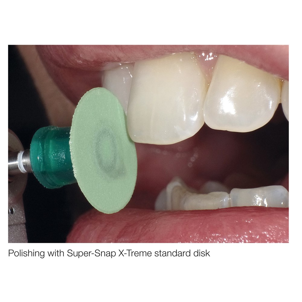 SUPER SNAP XTREME MINI  KIT CA