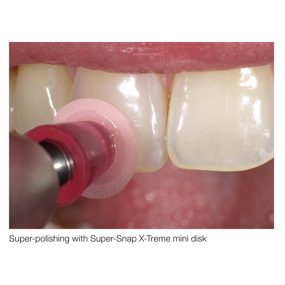 SUPER-SNAP X-TREME FINE MINI RED  DOUBLE SIDED 50 PACK